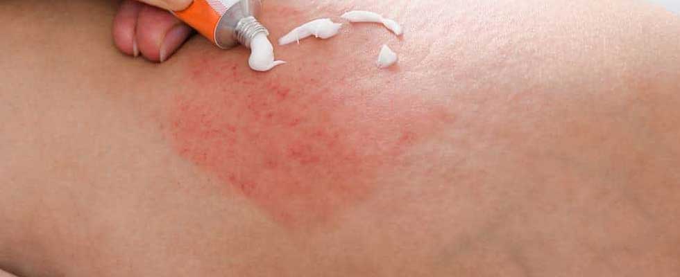 داروهای مکمل: قرص و امپول برای اگزما