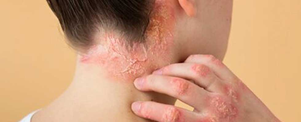علائم و نشانه های اگزمای پوستی