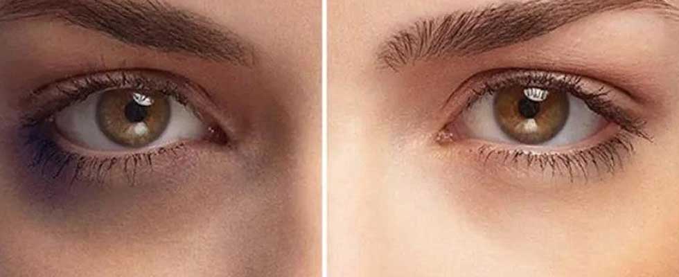مراقبت های سریع برای رفع تیرگی