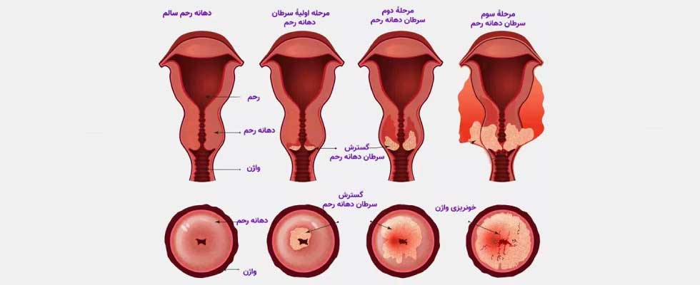 گروه های هدف برای دریافت واکسن گارداسیل ۹