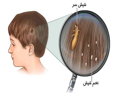 شپش سر