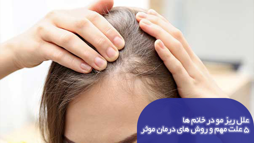 علت ریز مو در خانم ها