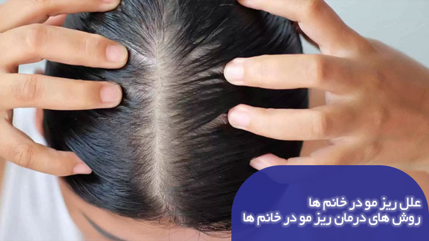 علت ریزش مو در خانم ها