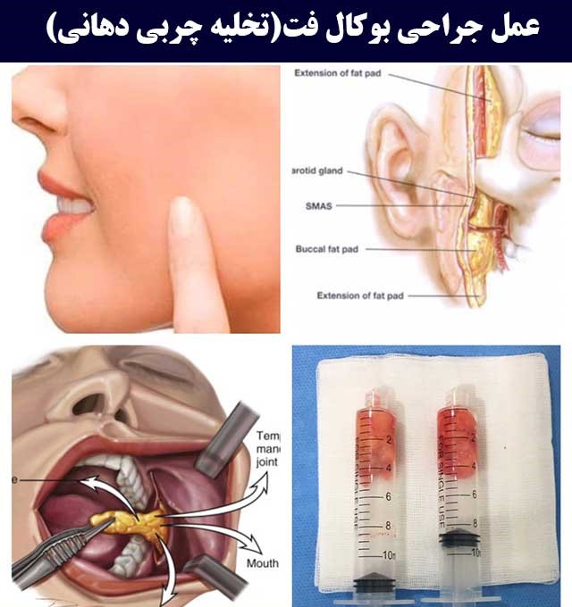 بوکال فت چیست