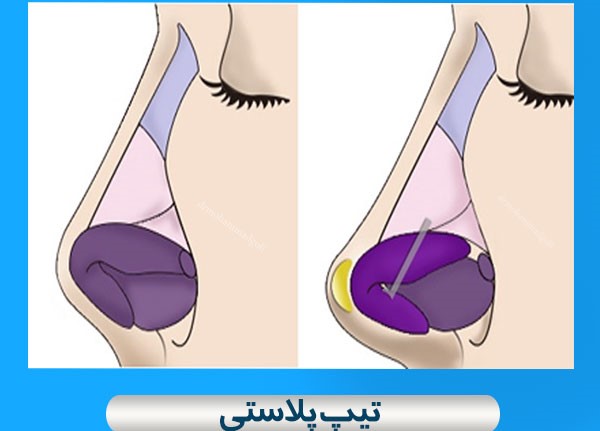 عمل تیپ پلاستی چیست