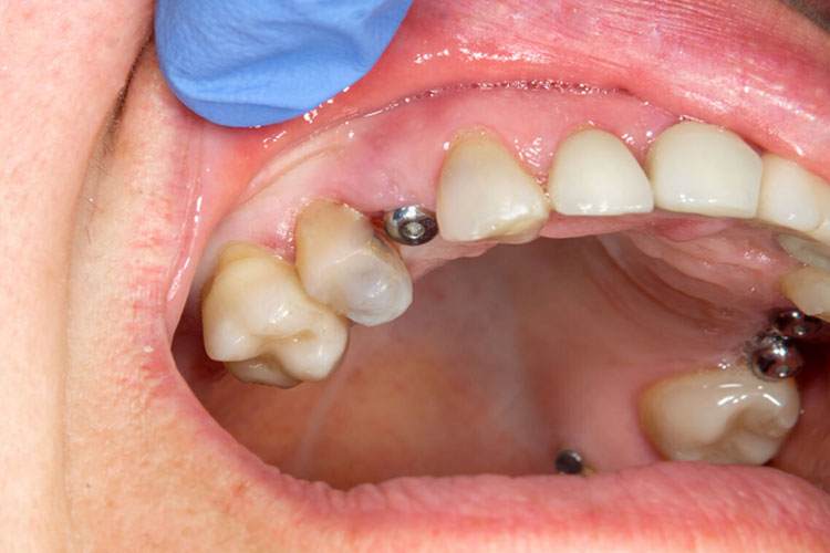 برخی از دلایل اهمیت دندانپزشکی و حفظ سلامت دهان و دندان