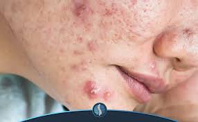از بین بردن جوش صورت در یک روز