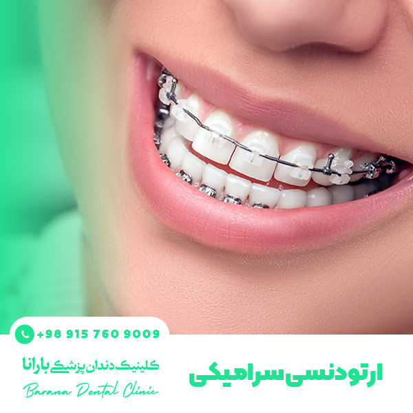 ارتودنسی سرامیکی دندان 