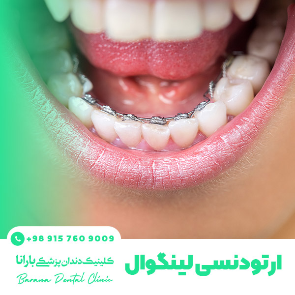 ارتودنسی لینگوال یا پشت‌دندانی