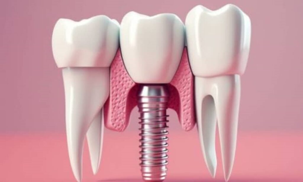 اگر پیچ ایمپلنت بیفتد چه کنیم؟ + علت درآمدن پایه ایمپلنت