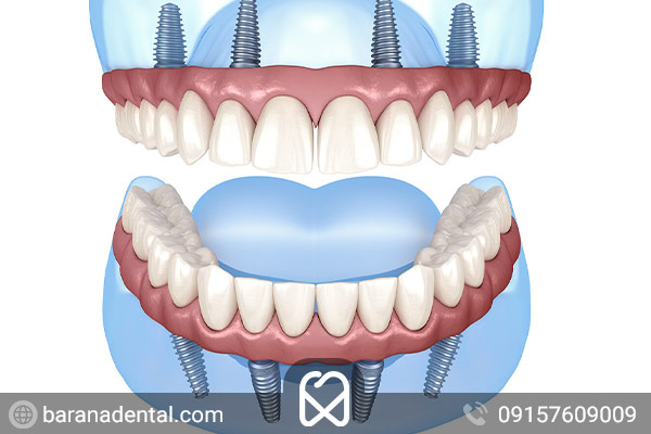 ایمپلنت آل آن فور، بهترین انتخاب برای ایمپلنت کامل دو فک.