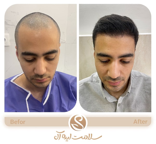 بهترین سن برای کاشت مو آقایان ( سن مناسب کاشت مو )