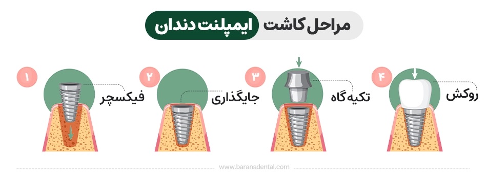 مراحل جراحی ایملپنت دندان