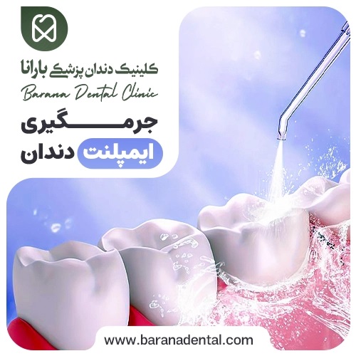 جرمگیری ایمپلنت دندان برای افزایش طول عمر آن ضروری است.