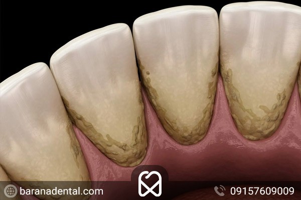تارتار موجب سیاه شدن دندان می‌شود.