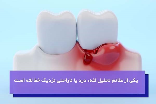 تحلیل لثه چقدر اهمیت دارد؟