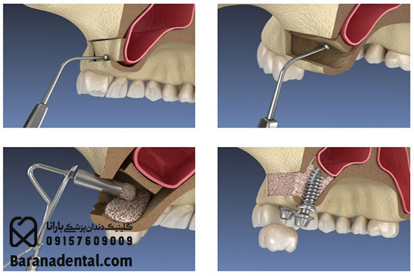 لیفت سینوس یکی از پرتکرار ترین درمان های قبل از ایمپلنت دندان است.