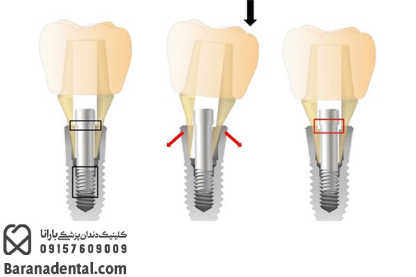 شل شدن ایمپلنت بر اثر یکپارچگی ناکافی استخوان فک