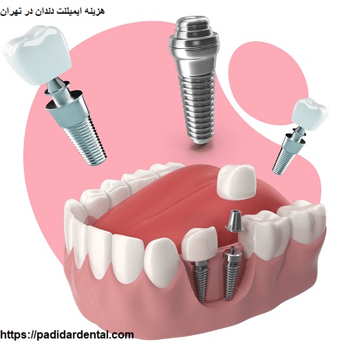 ایمپلنت | تهران