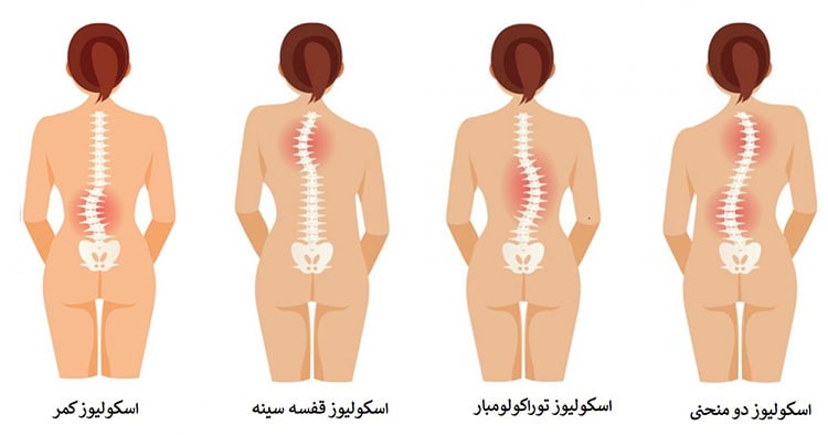 علل و عوامل خطر بروز اسکولیوز